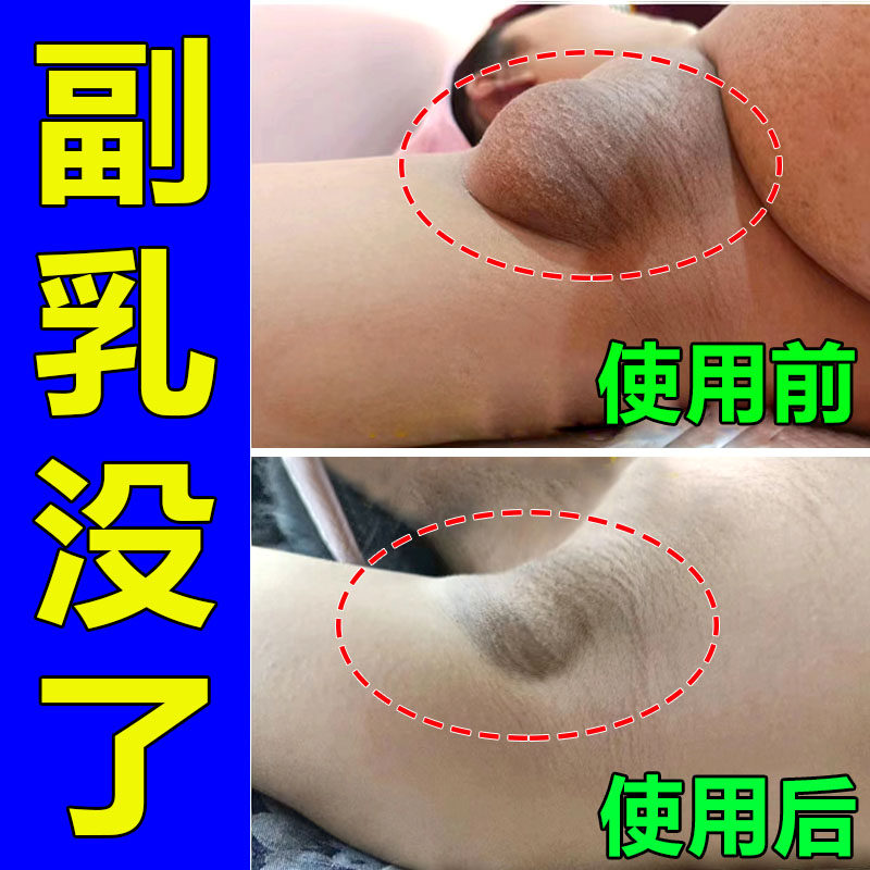 热销【 专攻液下淋巴】收副乳消除帖 消淋巴解散结 去腋下结节XY