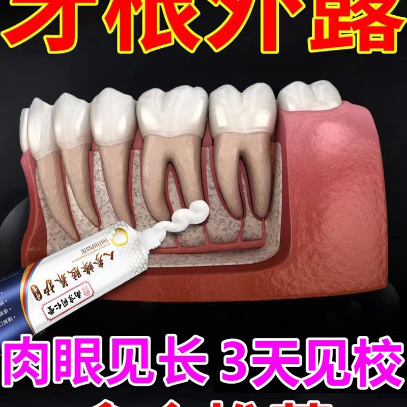 工厂销【重度牙龈萎缩】护龈固齿退缩牙齿敏感松动正Y畸牙龈出血
