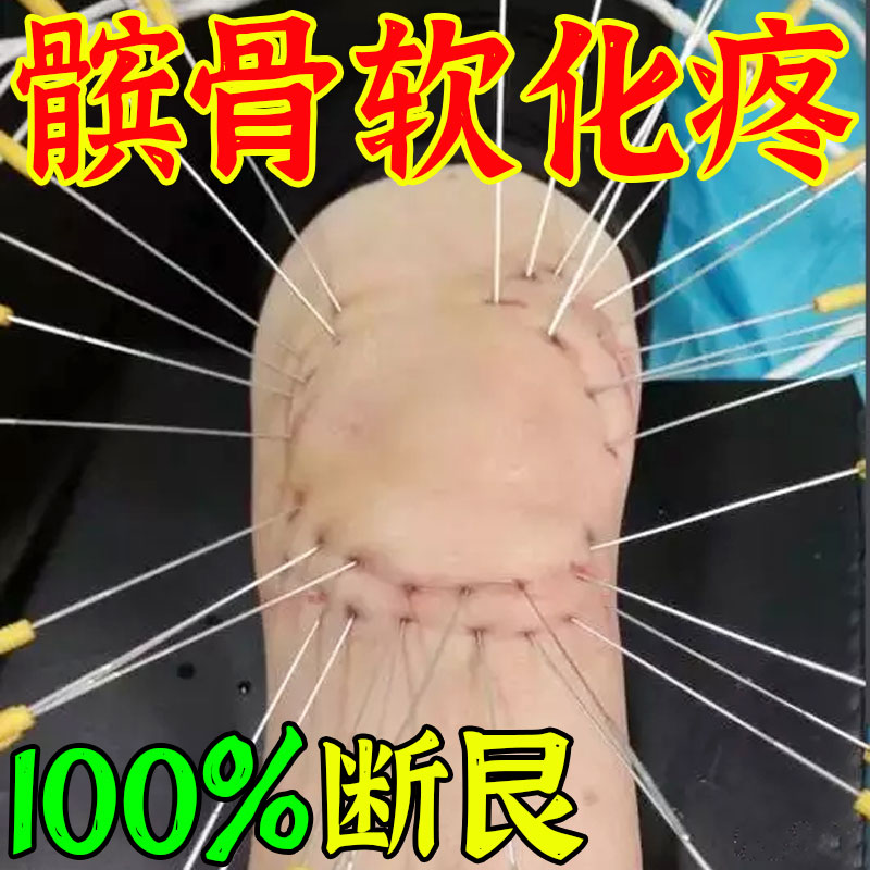热销髌骨痛贴膏软化症(再无疼痛)膝盖软骨带治积液半月板损伤髌