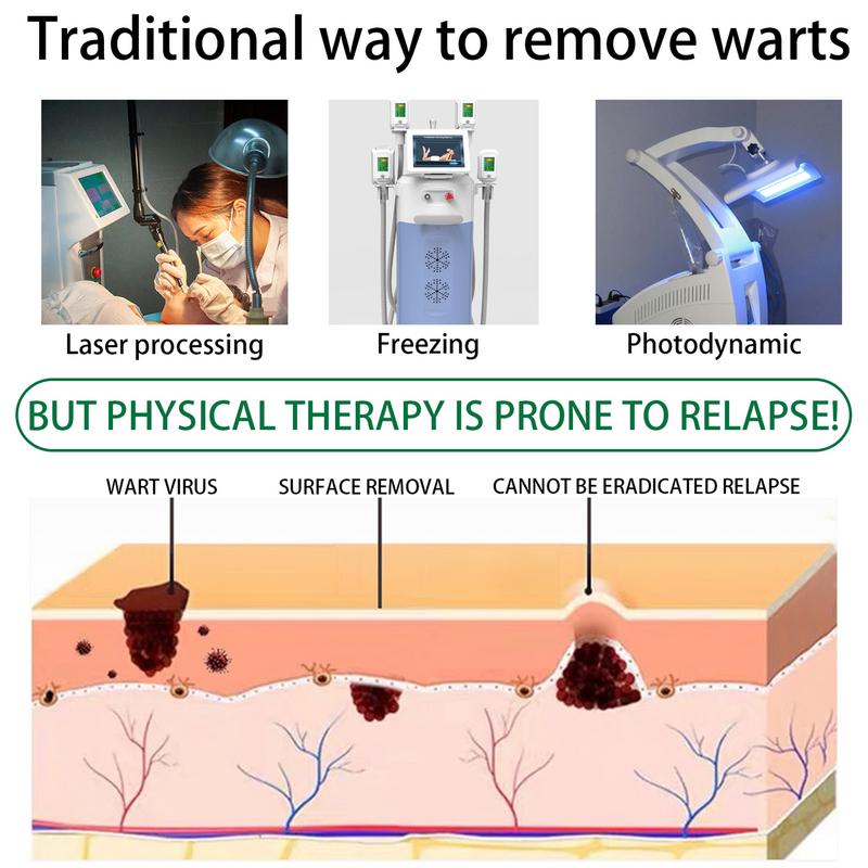 推荐Wart Remover Liquid Effective Removal Of Flat Warts Reme