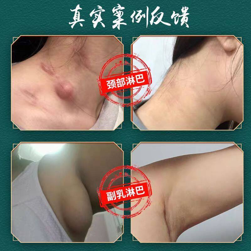 淋巴结散结膏颈部耳后腋下淋巴结发炎硬块红肿热痛淋巴肿大炎消贴