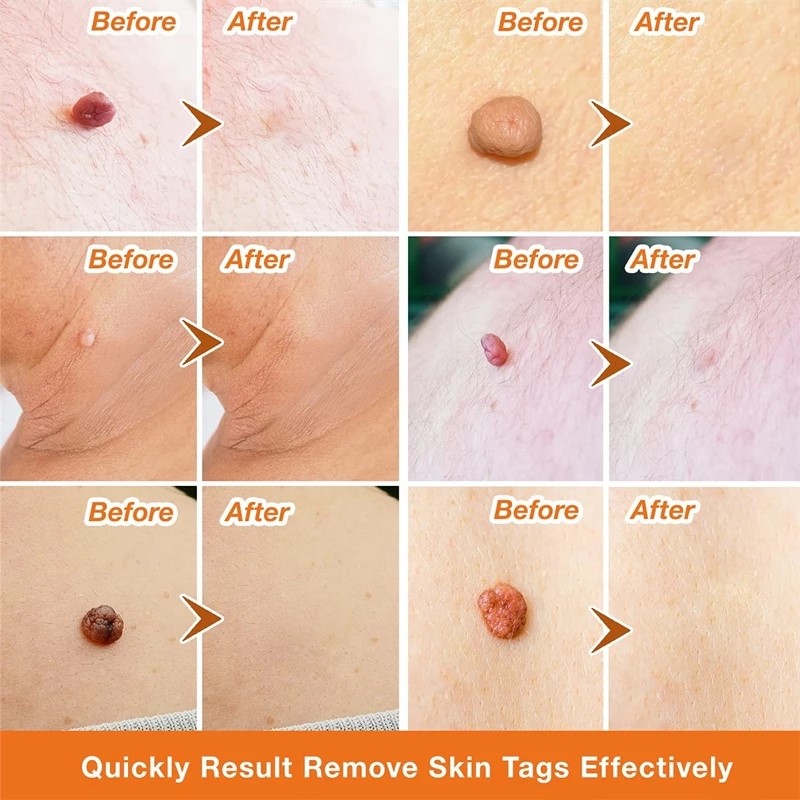 网红Skin Tag Remover Cream Painless Mole Skin Dark Spot Wart