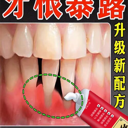 工厂销100%治好牙o松】牙齿洁离剂牙齿松动固齿牙膏修复牙萎缩专
