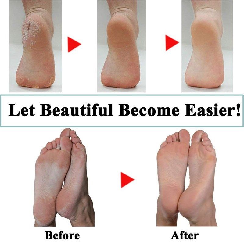 *15 Packs of Blue Replacet Rollers for Amope Pedi Refills Co