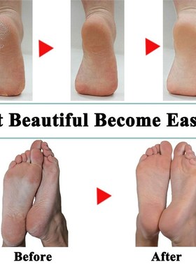 *15 Packs of Blue Replacet Rollers for Amope Pedi Refills Co