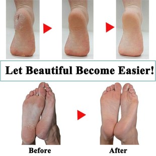 *15 Packs of Blue Replacet Rollers for Amope Pedi Refills Co