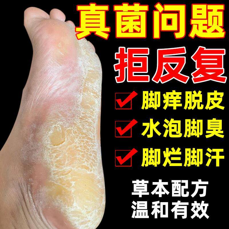 脚底起小水泡又痒又脱皮脚上真菌感染专用药膏手藓干裂足部癣药膏