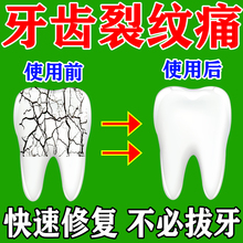 牙齿裂纹专用牙裂牙龈出t血萎缩红肿裂痕牙齿松动敏感裂缝咬合痛