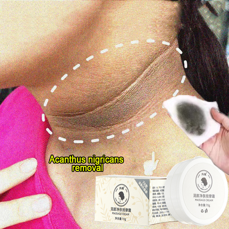 推荐Anti Acanthosis Nigricans Whitening Cream Remove Melanin