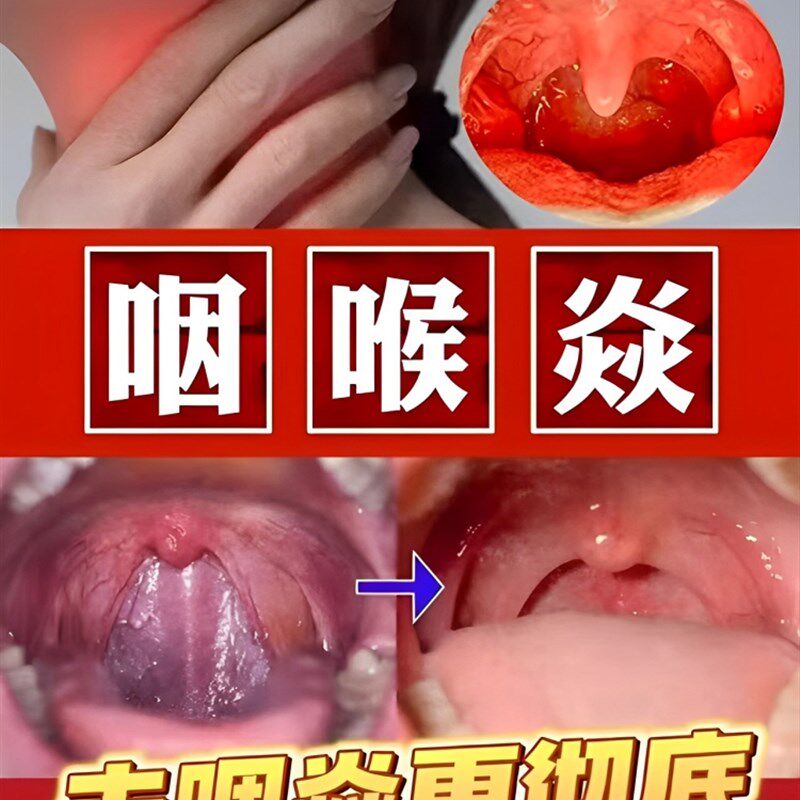 新品治疗咽炎慢性咽炎除根咽喉炎喉咙有痰异物感咳嗽喷雾贴专用特