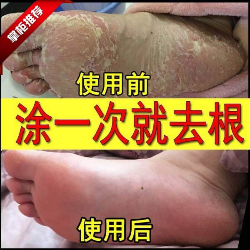 手脚脱皮起皮水泡型烂脚v水泡蜕皮脚趾缝脚底脚痒长水上起有