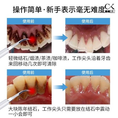 掏剔抠牙结石神器扣牙石清理刮牙垢器清除工具去除器头专业声波