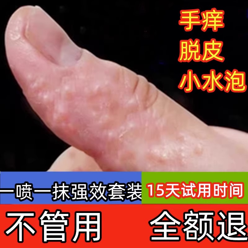 速发手上起小水泡手痒手指长汗状疱疹专用软膏汗包膏汗泡膏汗孢疹