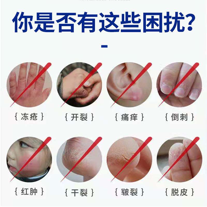 现货速发治手裂的药膏防手裂蜕皮开裂干脱皮止痒手气季节性反复型