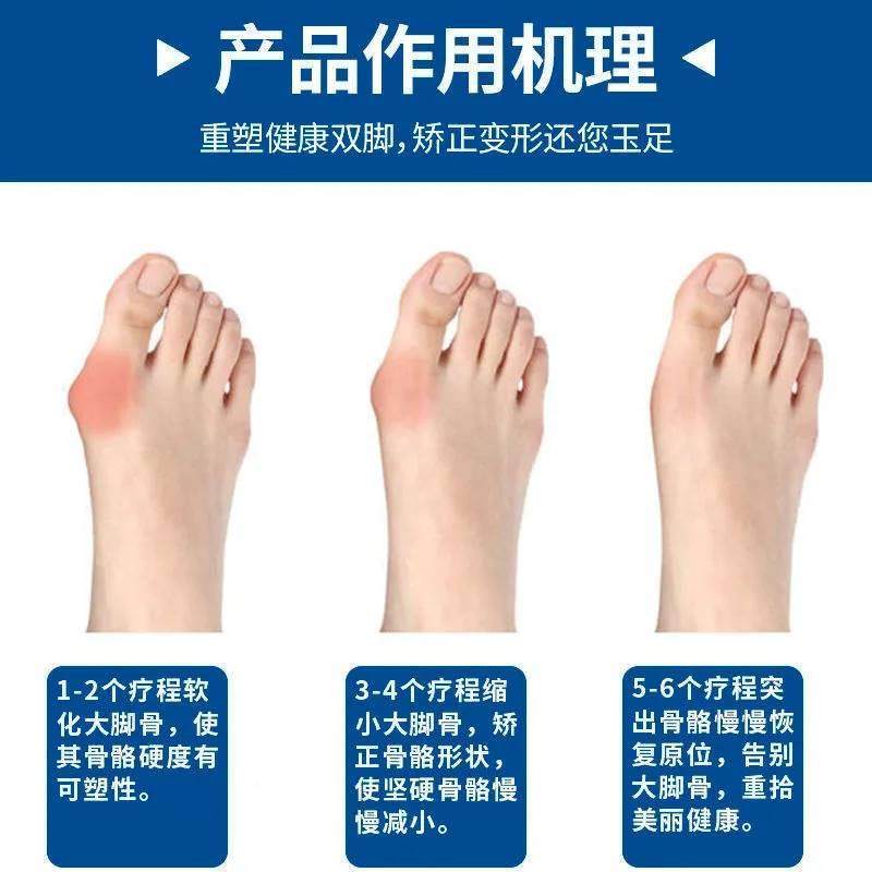 工厂销拇指外翻贴脚趾重叠大w脚骨变形突出矫正器严重拇外翻专用