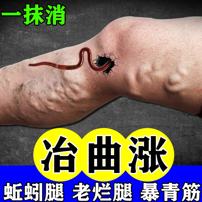 热销【100%冶好曲张】静脉曲涨特效膏抹平老烂腿青筋凸起冷敷凝胶