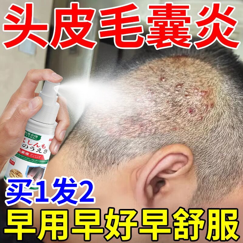 头癣藓顽固毛囊炎脂溢性皮焱疙瘩头皮屑杀菌止痒去屑顽固专用喷剂