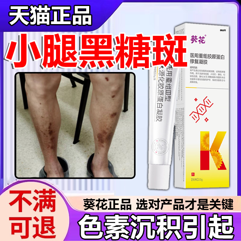 胫前糖斑膏糖尿病复疤痕印小腿黑斑黑色素修烂足伤口愈合祛腐p1科
