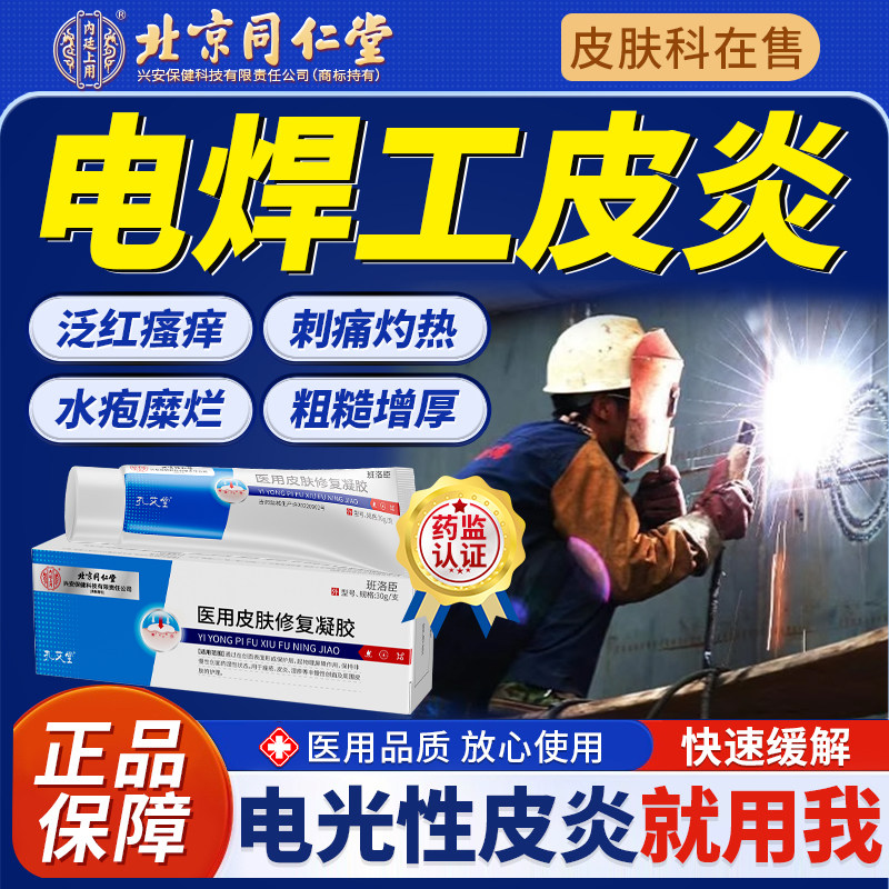 电焊工脸电光性皮炎软膏烫烤烤伤止痒红灼热刺挠痛二保焊弧光u9科