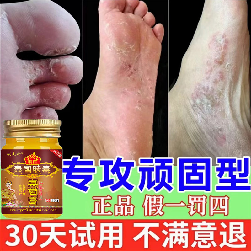 泰国脚气王烂脚丫脚水痒泡脚脱皮糜烂脚臭脚汗真菌手气脚气膏外用