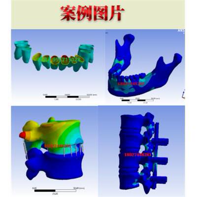 mimics代做 牙齿有限元 三维重建 生物力学 ANSYS分析