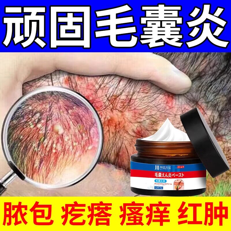 毛囊炎专用头皮脂溢性皮炎瘙痒长痘有疙瘩全身除螨祛痘痘头癣脓包