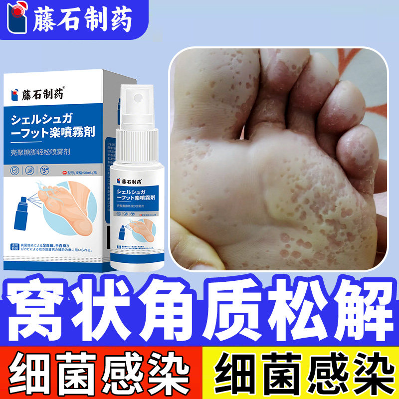 窝状角质松解症脚底发白发臭脚底板蜂窝状脚气真菌感染泡沙虫脚SY