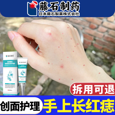 藤石制药血管瘤血管痣除蜘蛛痣樱桃状手上小红点痣凝胶创面专用E8