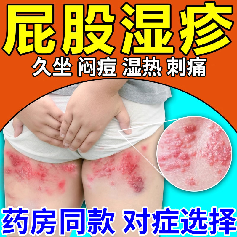 屁股湿疹专用除湿止痒膏慢性股藓久坐长痘股廯湿毒清软膏TU