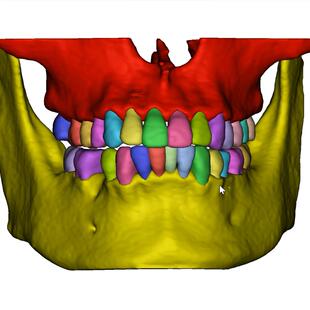 Mimics 3D Slicer全身骨骼脏器血管心脏肝胆胸外医学三维重建代做