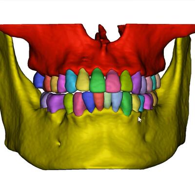 Mimics 3D Slicer全身骨骼脏器血管心脏肝胆胸外医学三维重建代做