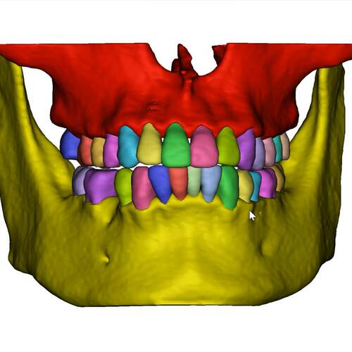 Mimics 3D Slicer全身骨骼脏器血管心脏肝胆胸外医学三维重建代做