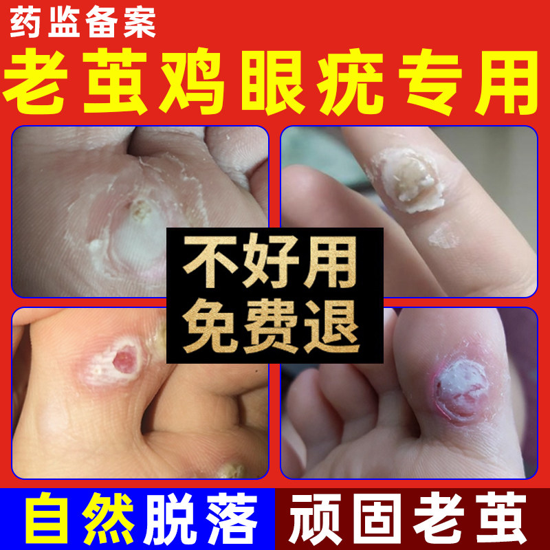 去除脚底鸡眼膏刺瘊趾疣脚底肉刺脚疣老茧脚钉鸡眼贴手足去除神器