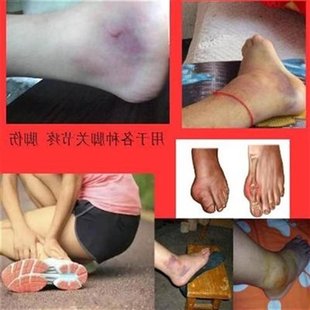 李要真崴脚脚疼脚肿扭脚了大拇指疼腱鞘疼脚踝扭伤肌肉Z韧带拉伤