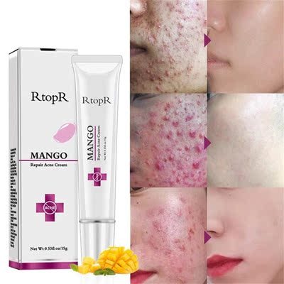RtopR 15g Natural Mango Extract Face Acne Remover Cream Acne