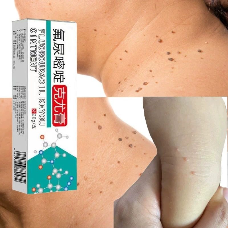 丝状忧去除神器脖子寻常忧腋下肉粒刺猴子皮赘扁平尤专用氟尿嘧啶
