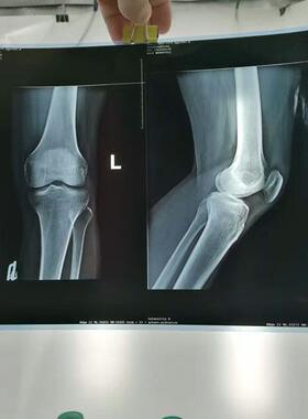 医用胶片喷墨蓝片干式放射科打印胶片牙科骨折X光片 DR CR CT