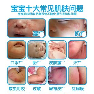 桂林中医院成人儿童止痒湿红屁屁护臀疹膏儿童宝宝新生儿医院代购