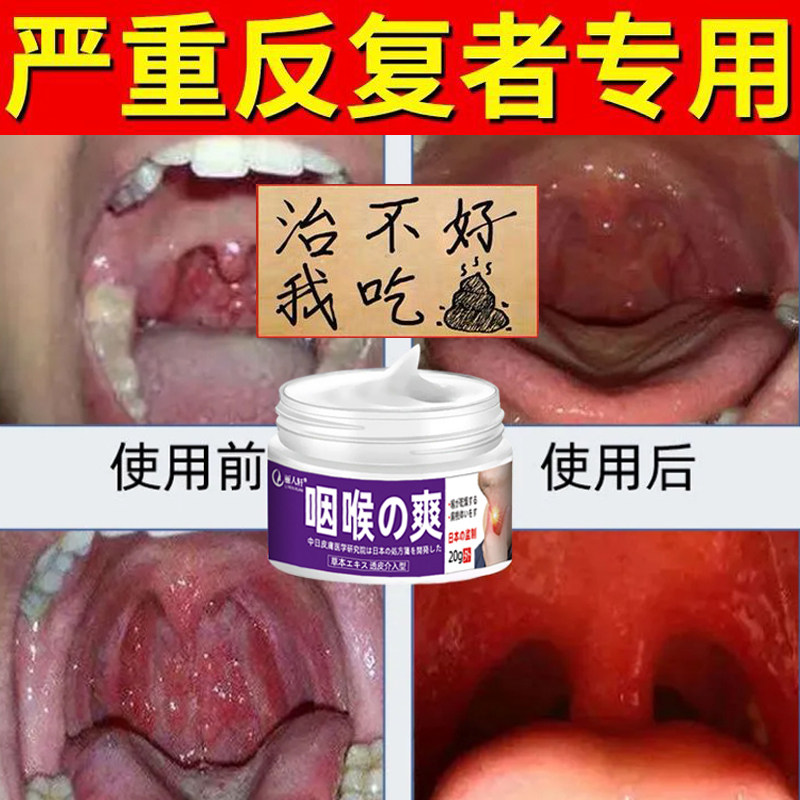 扁桃体发炎肥大肿大喷剂咽喉肿痛滤泡增生干痒喉咙有痰异物感喷雾