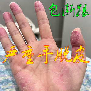 手脱皮严重脱皮用什么药蜕皮干燥起皮药膏护手霜脱皮干裂真菌草用