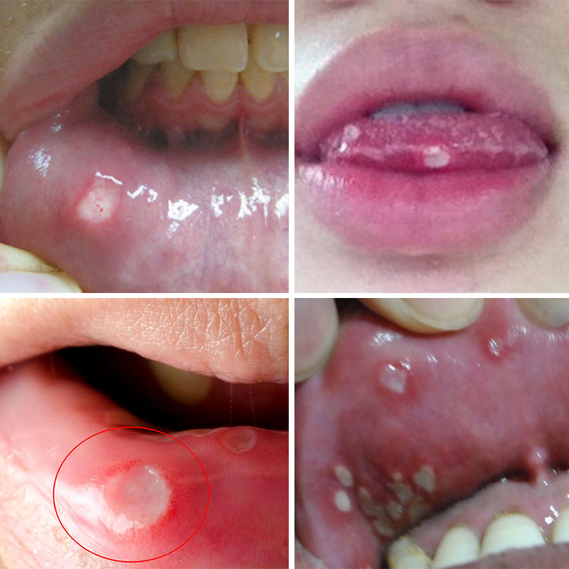 【小红书推荐】口腔上火嘴巴烂舌头起泡喷剂30ml粘膜修复防溃喷雾