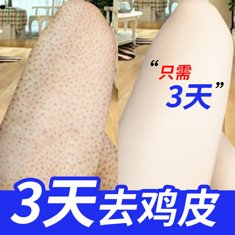 身体乳美白保湿尿素霜去鸡皮肤疙瘩毛囊角质角化女腿部鱼鳞病去除