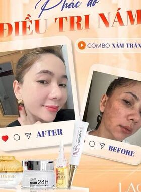 越南面霜Combo4 sp kem tri nam trang da hoa nhung tuyet(nho)