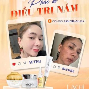 越南面霜Combo4 sp kem tri nam trang da hoa nhung tuyet(nho)