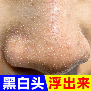 深层清洁毛孔脏东西脸部堵塞污垢 小红书达人推荐 毛孔吸尘器