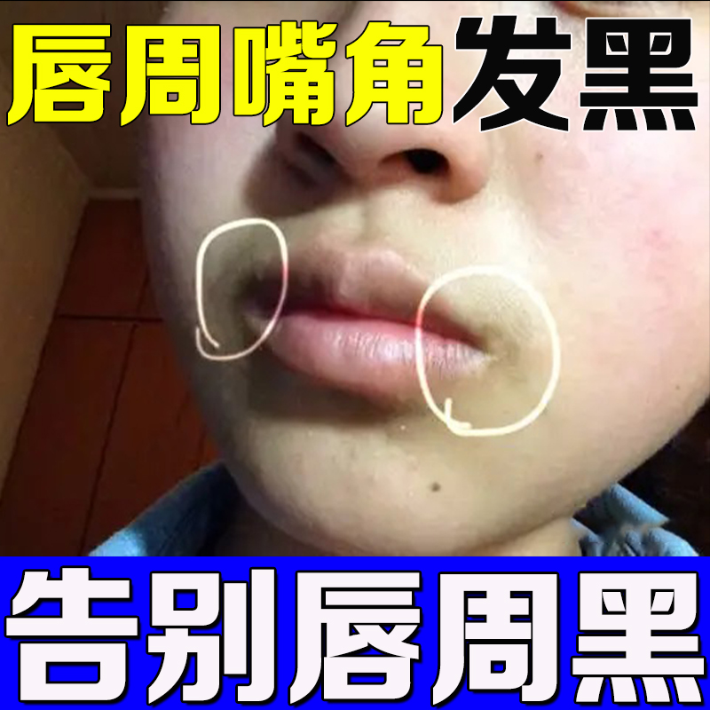 小红书热销~去唇角边黑改善嘴角发黑 周围发紫唇部炎去除黑色素~
