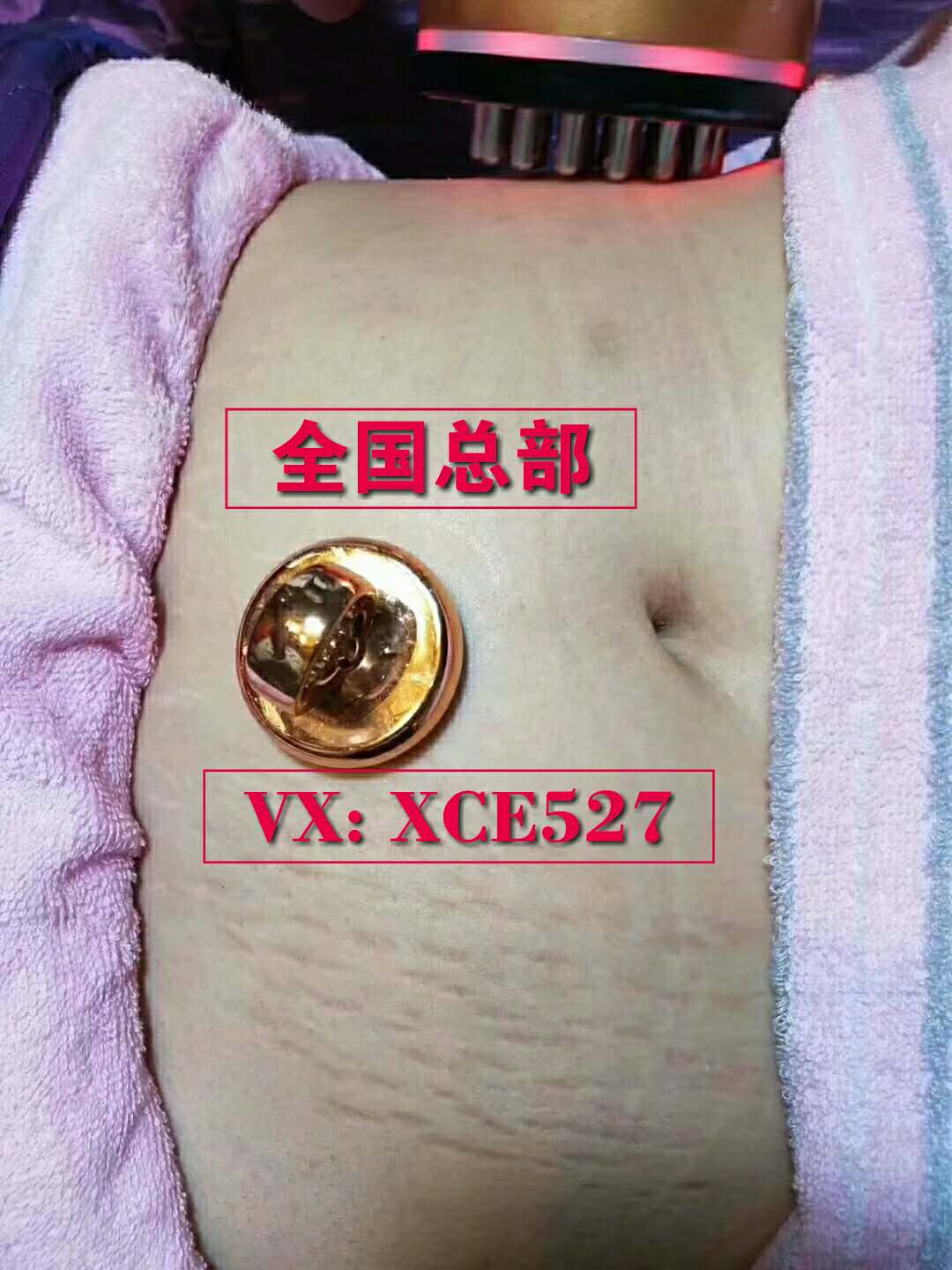 [Ling家小铺 898妊娠纹护理]抖音同款去除妊娠纹仪器修复霜豹纹妈妈月销量0件仅售1980元