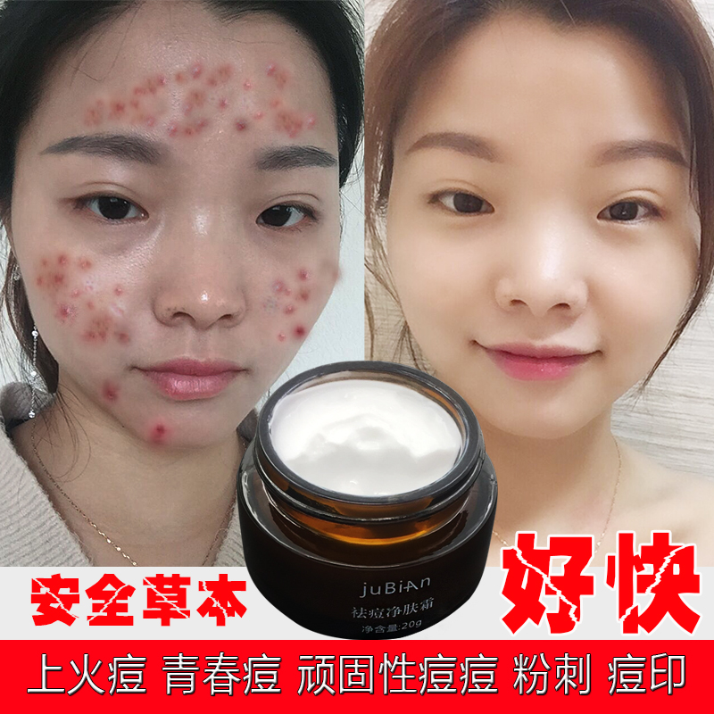 巨變祛痘膏痘印淡化膏痘坑痘疤蘆薈膠修復霜前女五男士強