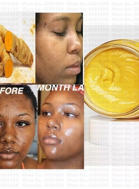 Tumeric Apple cider Face Mask Spotless Skin Dark Spots remov