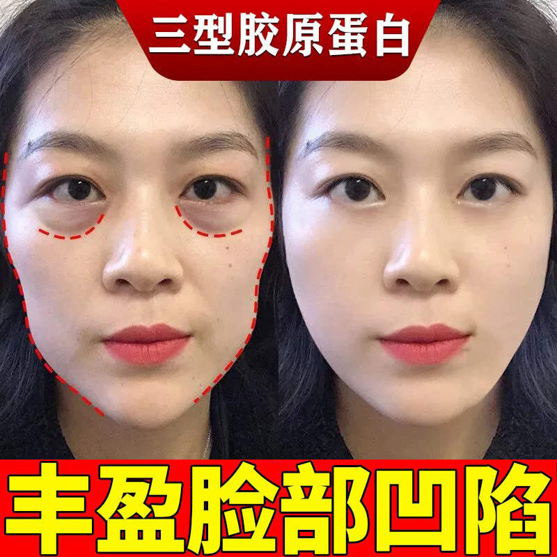 三型胶原面部丰盈精华不回落抗皱紧致去皱纹法令纹泪沟充实除神器